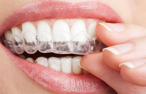 بلیچینگ یا سفید کردن دندان در خانه
