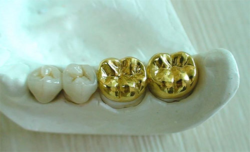 روکش فلزی دندان