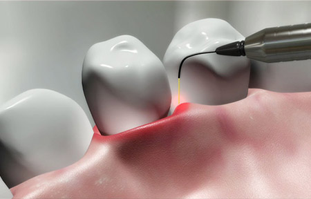 کاربرد لیزر در جراحی های زیبایی لثه