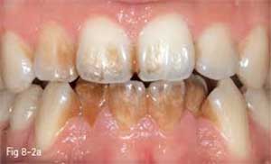تغییر رنگ دندان بر اثر جرم دندان