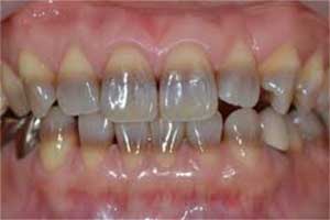 تغییر رنگ دندان بر اثر مصرف دارو